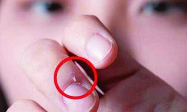 手起倒刺吃什么維生素,手指上長倒刺是因?yàn)槿狈S生素嗎圖1