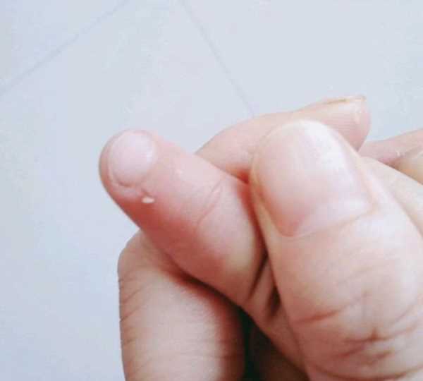 手起倒刺吃什么維生素,手指上長倒刺是因?yàn)槿狈S生素嗎圖3