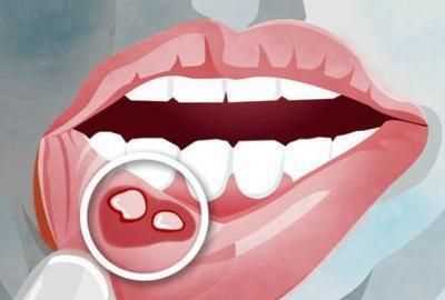 交泰丸治療反復(fù)口腔潰瘍