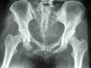 治療骨折的方法有哪些