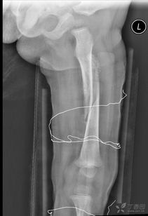 兒童骨折保守治療鍛煉方法有哪些