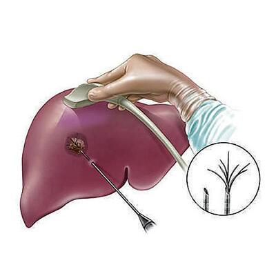 肝癌診斷方法有哪些