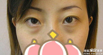 長沙去眼袋醫(yī)院有哪些方法