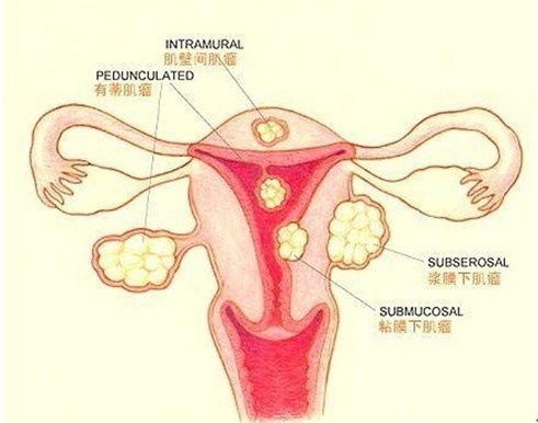 治療子宮瘤的方法有哪些