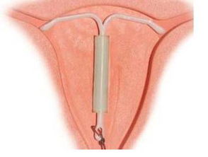 女人上環(huán)后需要注意些什么,帶環(huán)后注意什么,帶環(huán)后注意事項及飲食