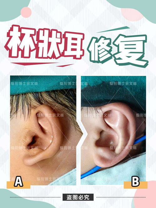 杯狀耳手術(shù)的注意事項