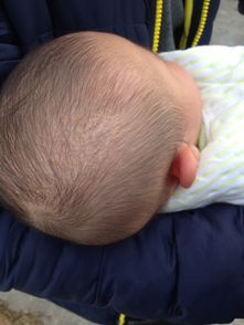 小兒頭皮注射注意事項