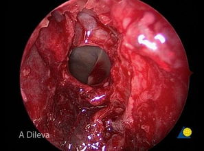 腦垂體,切除,注意事項
