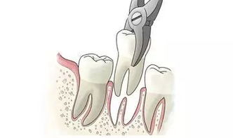 拔掉智齒后要注意什么,拔智牙之后注意事項與禁忌癥,拔完智牙注意事項飲食