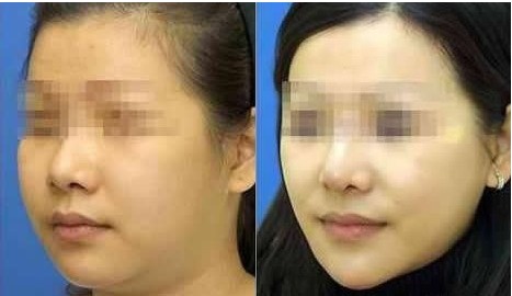 面部抽脂前后要注意事項(xiàng)