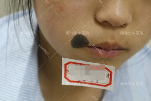 注意事項,治療,i131