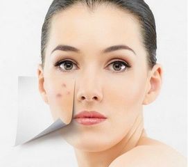 祛痘后注意事項,做完祛痘的注意事項,微針祛痘注意事項