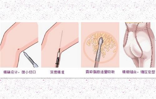 大腿環(huán)吸術(shù)后注意事項