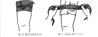 加壓包扎止血的注意事項(xiàng)