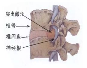 注意事項(xiàng),患者,腰椎間盤突出