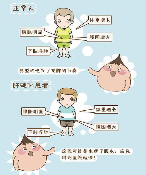 肝硬化患者飲食原則及注意事項(xiàng),肝硬化晚期患者飲食注意事項(xiàng),乙肝肝硬化患者飲食注意事項(xiàng)