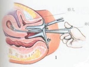 墮胎前的注意事項,流產(chǎn)手術(shù)術(shù)前注意事項,流產(chǎn)手術(shù)后的注意事項