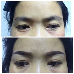 術(shù)后,注意事項