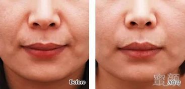 玻尿酸除法令紋后注意事項(xiàng)