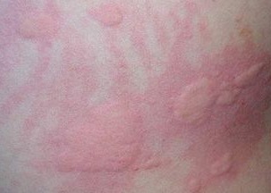 尋麻疹注意事項(xiàng)