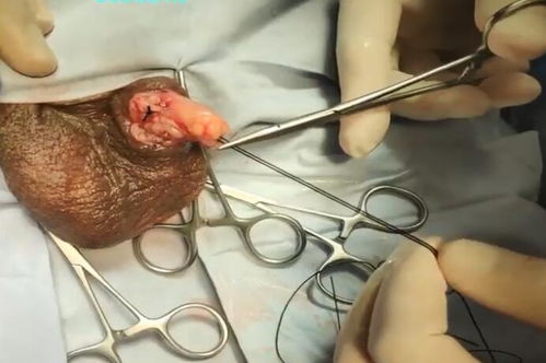 睪丸,切除,術(shù)前,注意事項