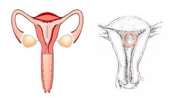 去節(jié)育環(huán)后的注意事項(xiàng)