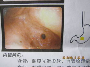 疣狀胃炎術(shù)后注意事項