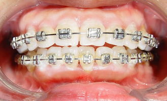 活動矯治器的注意事項,twinblock矯治器注意事項,隱形矯治器佩戴的注意事項