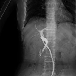 做輸卵管造影前后注意事項,做心臟造影前后注意事項,做造影后的注意事項