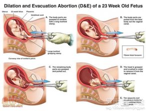 刮宮,無痛,注意事項(xiàng)