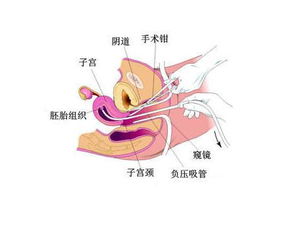 產(chǎn)后刮宮后注意事項(xiàng)