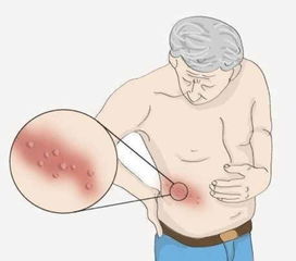 注意事項,飲食,蛇盤瘡