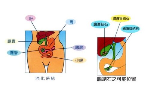 膽結(jié)石注意事項及飲食,膽結(jié)石患者注意事項,膽結(jié)石微創(chuàng)手術(shù)注意事項