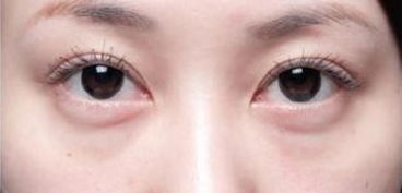內(nèi)切眼袋術(shù)后注意事項,割眼袋術(shù)后注意事項,去眼袋術(shù)后注意事項