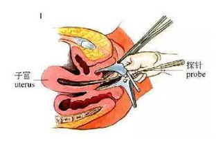 注意事項(xiàng),節(jié)育環(huán)