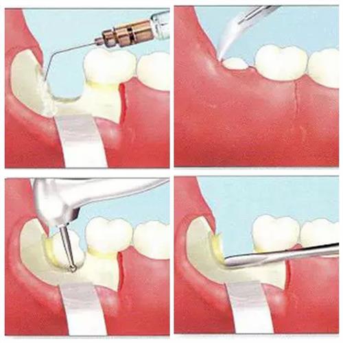 智齒,開刀,注意事項