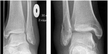 胸椎骨折兩個(gè)月應(yīng)注意事項(xiàng),腳踝骨折手術(shù)后回家應(yīng)注意事項(xiàng),老人腳踝骨裂后應(yīng)注意事項(xiàng)