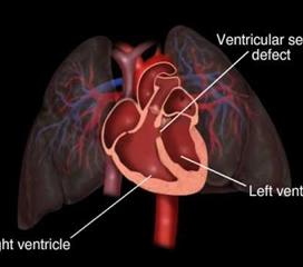 心室間隔缺損小孩兒術(shù)前注意事項(xiàng)