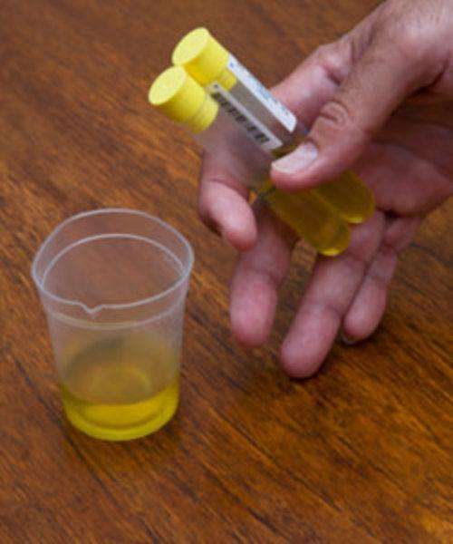 尿標(biāo)本收集注意事項(xiàng)