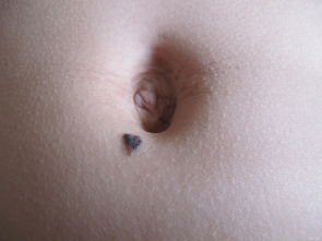 黑色素痣切除后注意事項