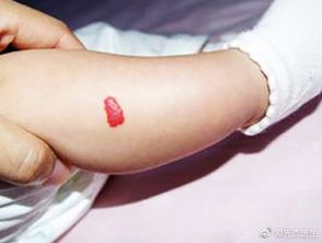 靜脈,注意事項(xiàng),血管瘤