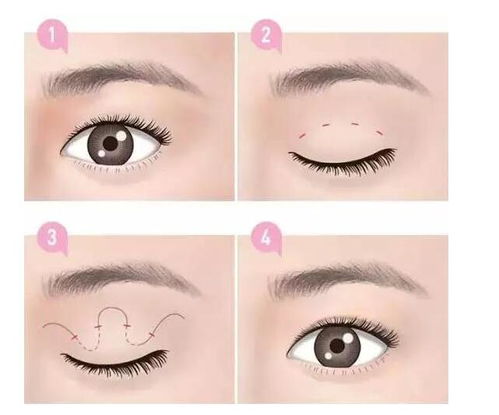 割雙眼皮注意事項?,做完雙眼皮睡覺注意事項,割雙眼皮前期注意事項