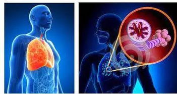 慢性阻塞型肺氣腫用氧注意事項