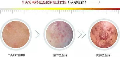 粉刺,注意事項(xiàng),清理