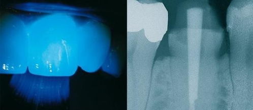 牙齒打樁注意事項(xiàng)