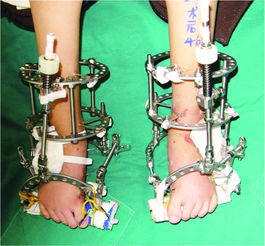 外固定支架的注意事項
