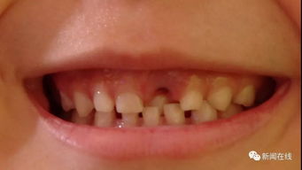 注意事項(xiàng),拔多生牙前