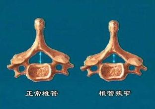 脊椎,狹窄,注意事項