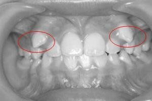 拔多生牙前注意事項(xiàng)