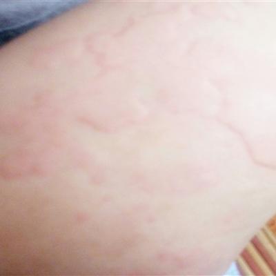 風(fēng)疹,注意事項(xiàng)